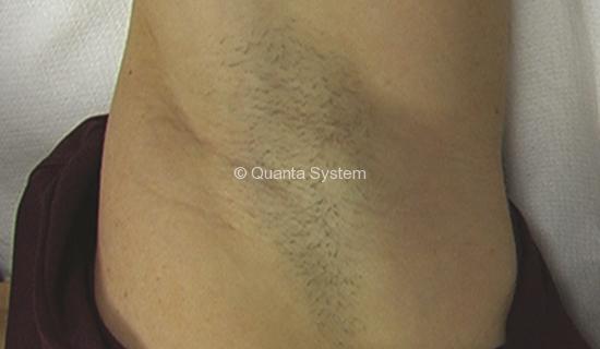 0001_Hair-removal-ascella-B