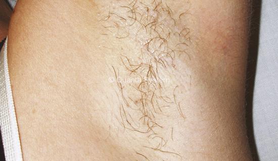0002_Hair-removal-ascella-B
